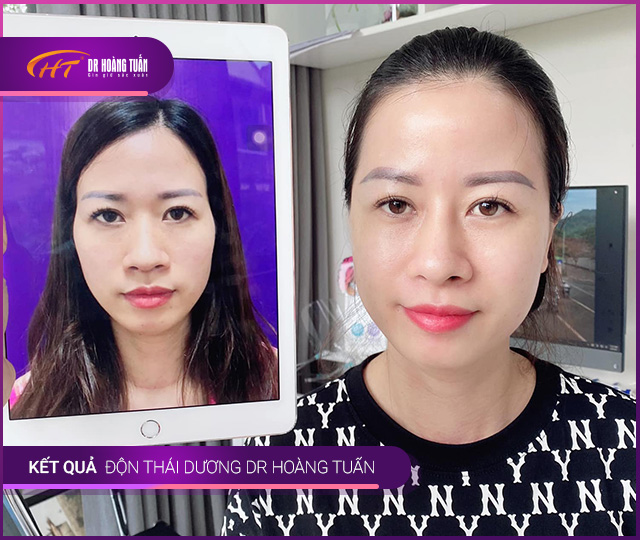 Kết quả độn thái dương tại Thẩm mỹ Hoàng Tuấn